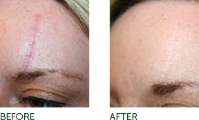 Non-Surgical Facelift Pittsburgh