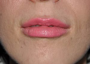 Botox, lips and lip line, after