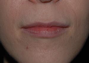 A woman's mouth, lips fuller and the lip line more defined, before