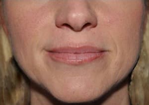 Botox, mouth and nasolabial folds, after