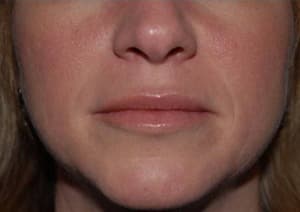 Botox, mouth and nasolabial folds, before
