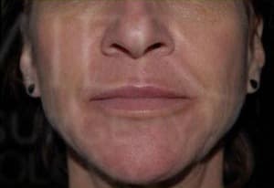 Botox, perioral lines, after