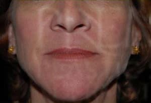 Botox, perioral lines, before