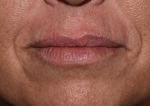 Botox, lip contour, after