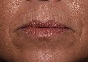 Botox, lip contour, before