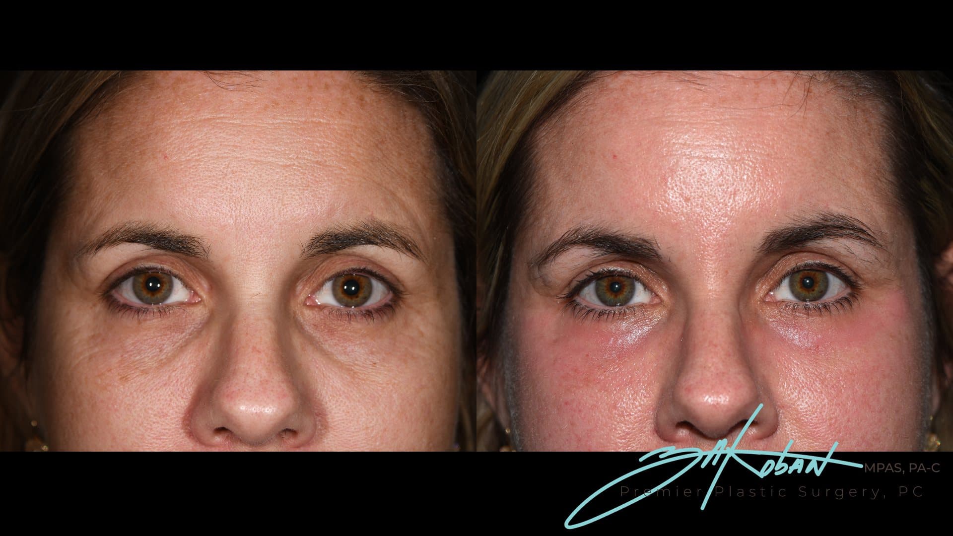 CO2 Laser Resurfacing, Patient 1, front: before and after