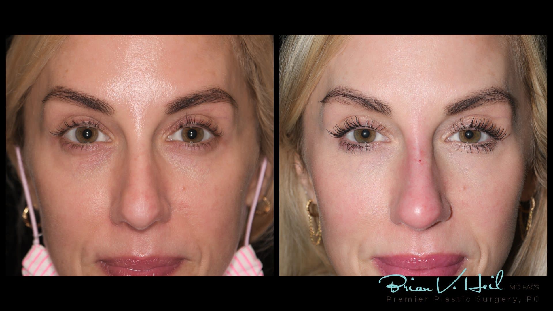 CO2 laser resurfacing, Patient 2, front: before and after