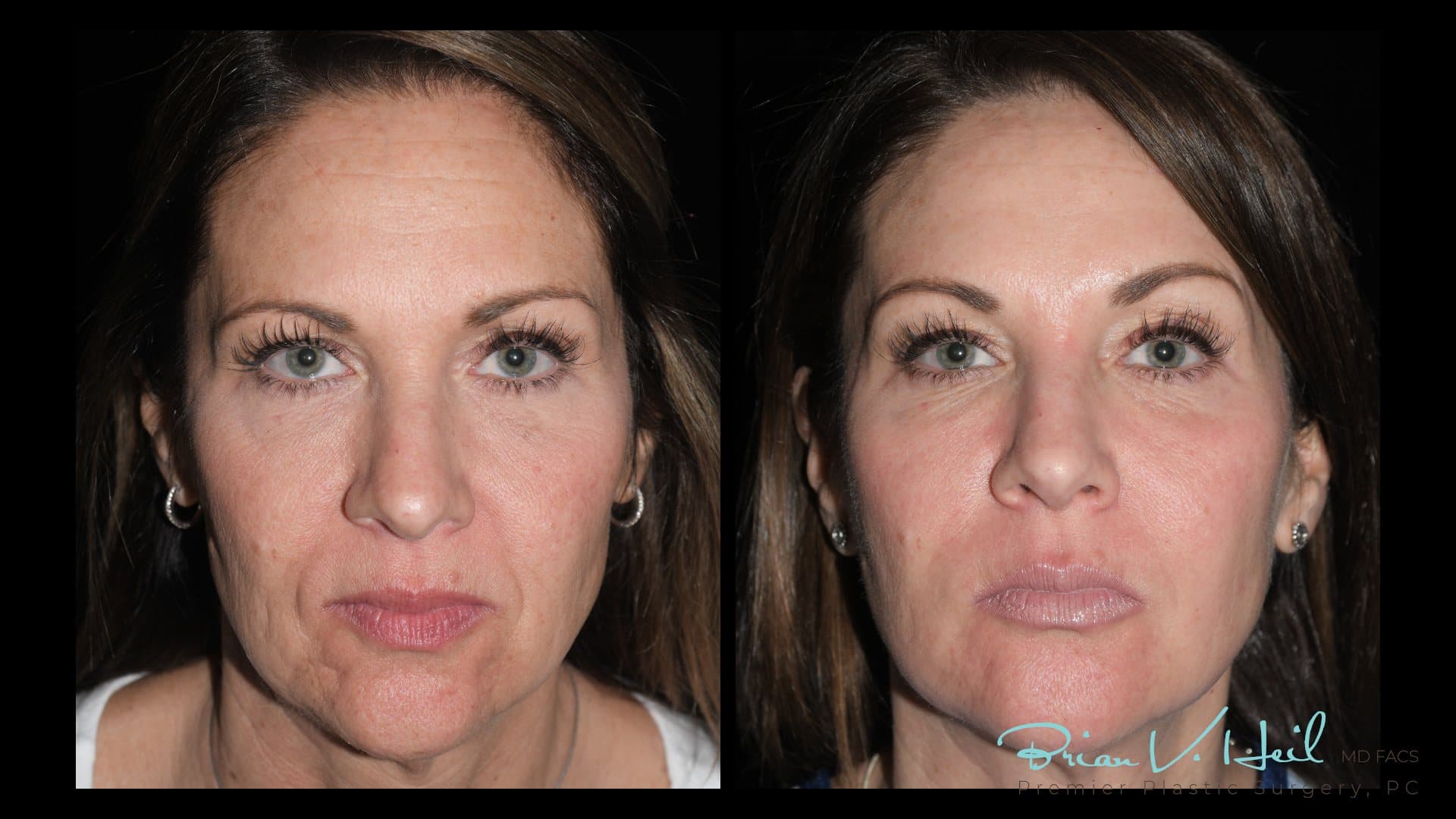 CO2 Laser Resurfacing, Patient 3, front: before and after