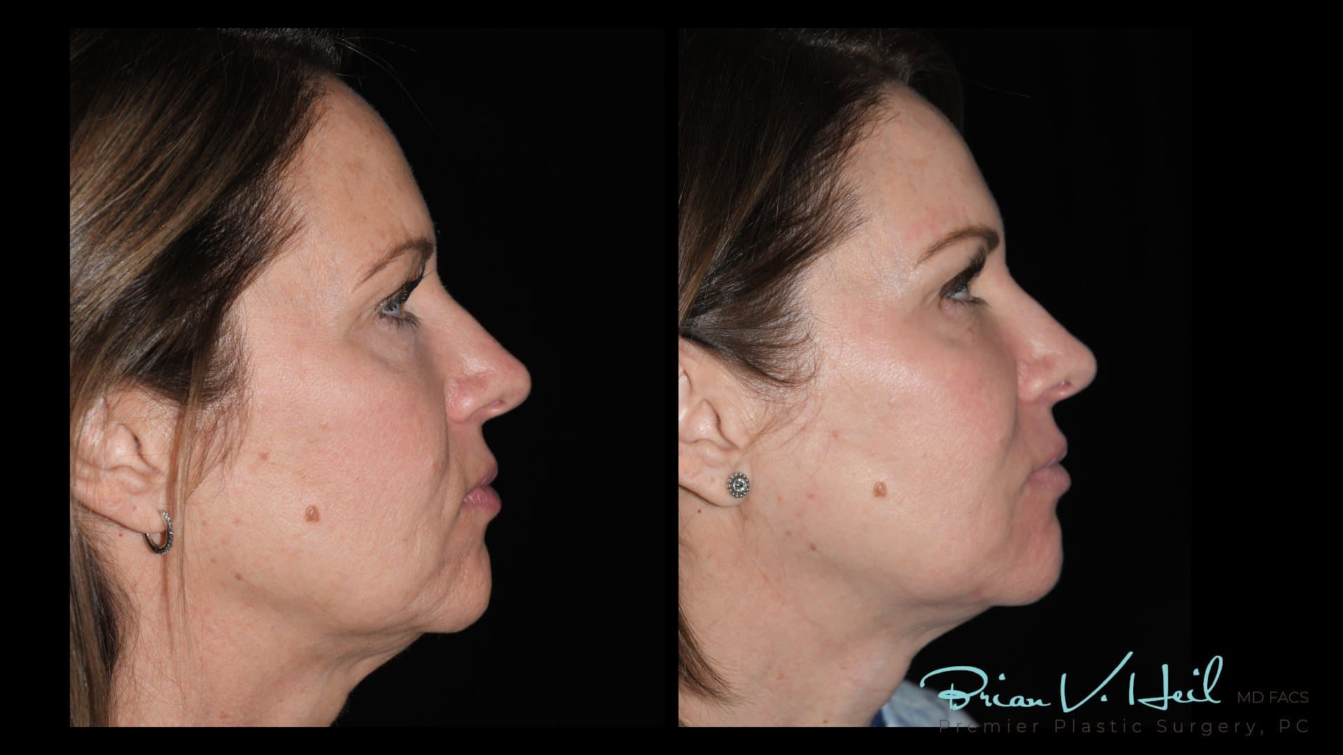 CO2 laser resurfacing, Patient 3, profile: before and after