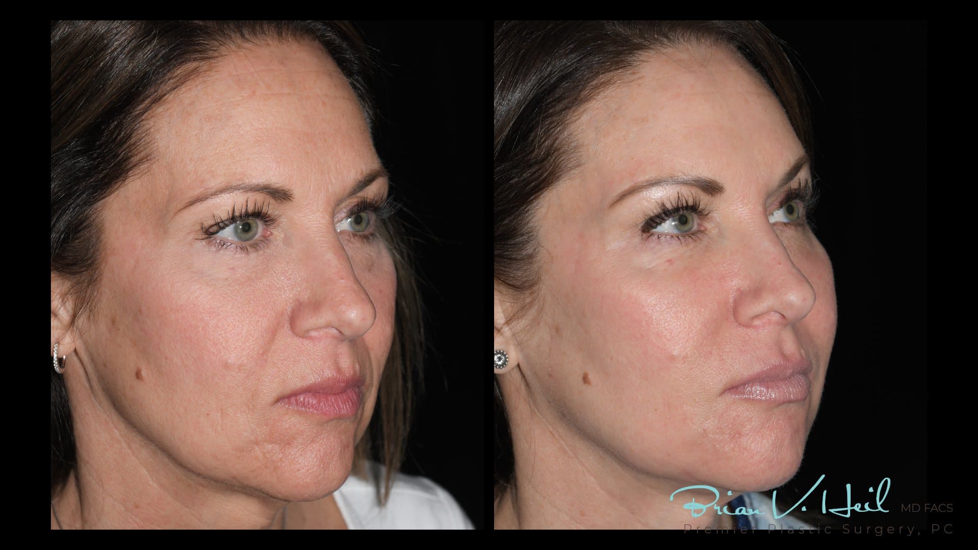 CO2 Laser Resurfacing, Patient 3, three-quarter: before and after