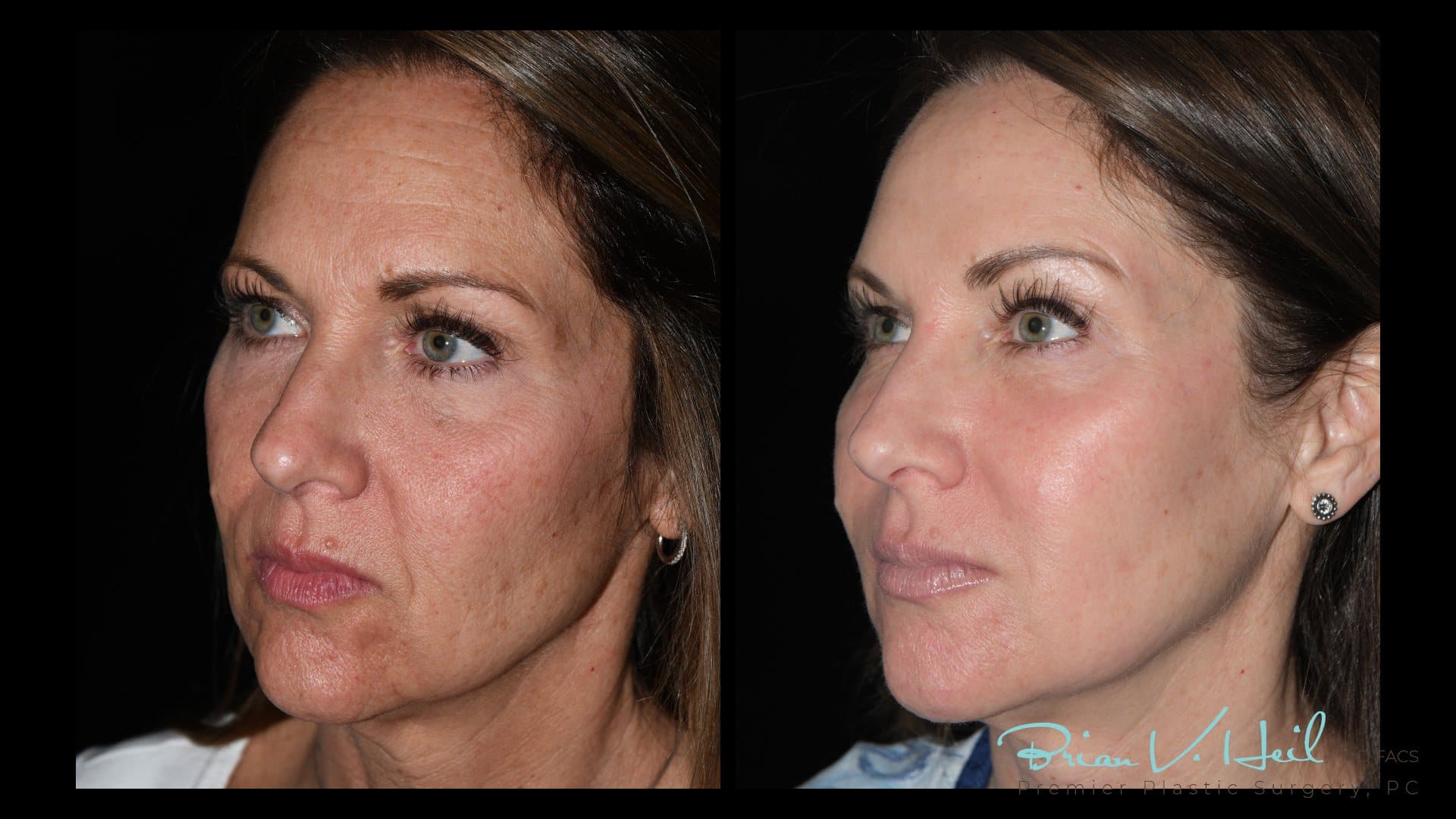 CO2 Laser Resurfacing, Patient 3, three-quarter, right: before and after