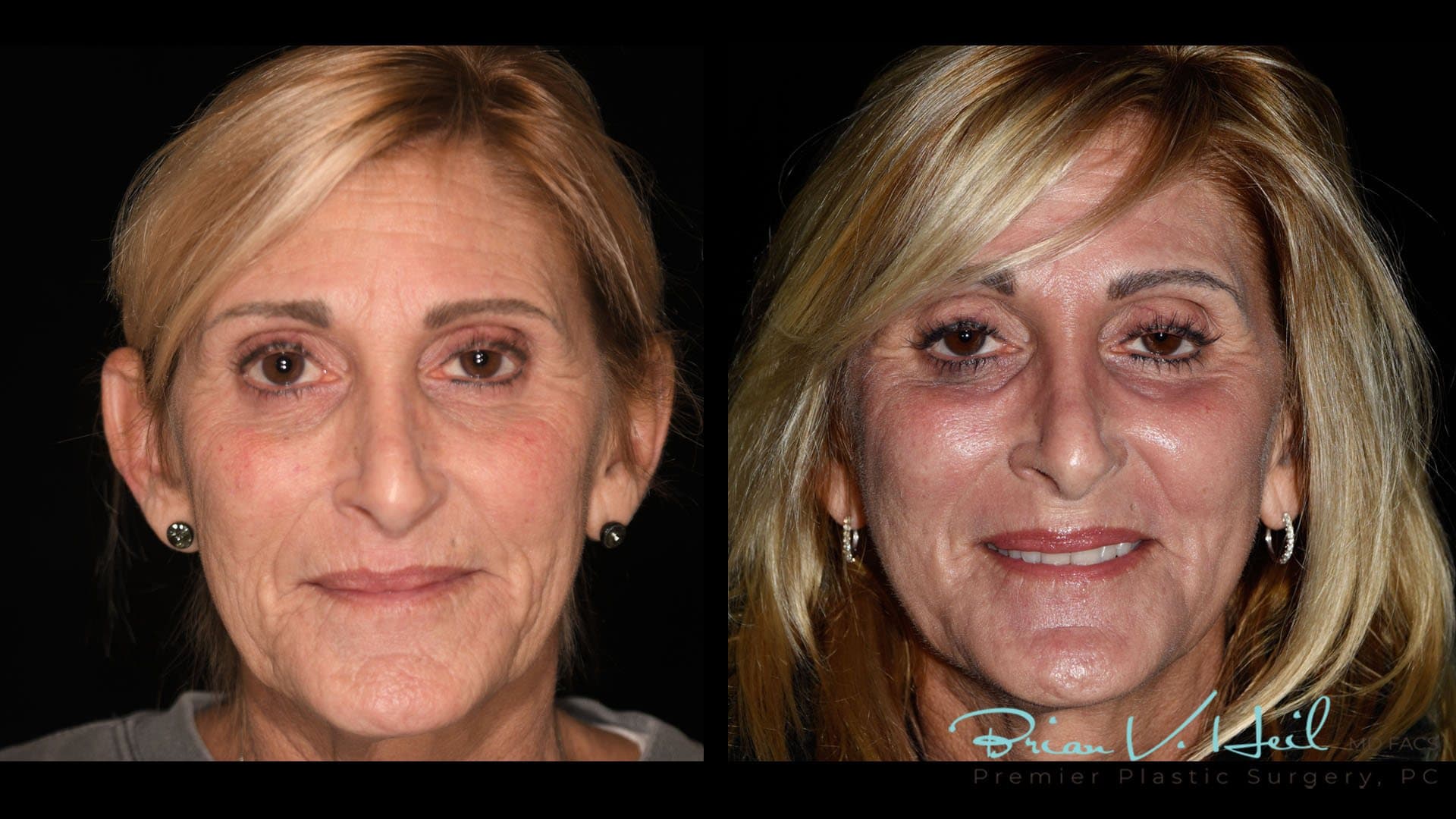 CO2 Laser Resurfacing, Patient 4, front: before and after