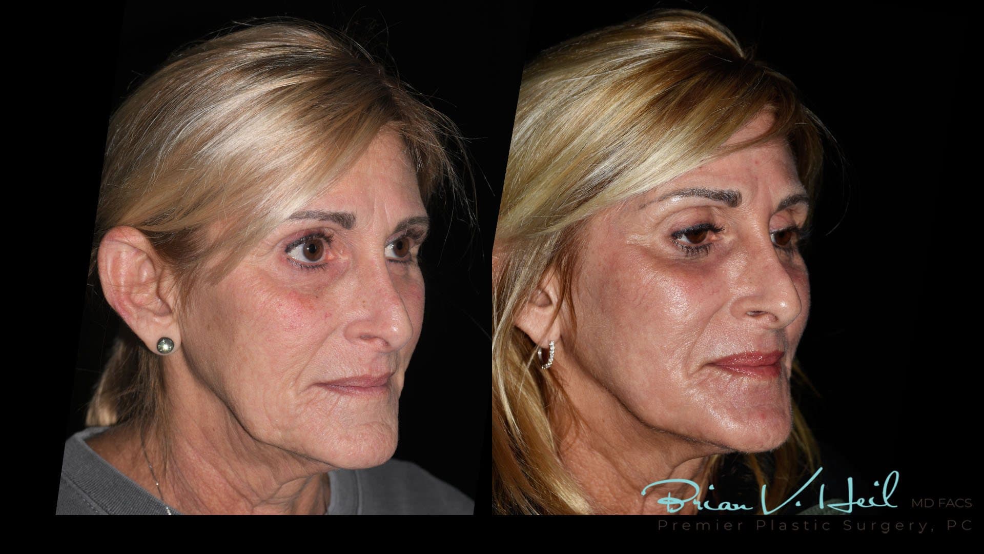 CO2 Laser Resurfacing, Patient 4, three-quarter: before and after