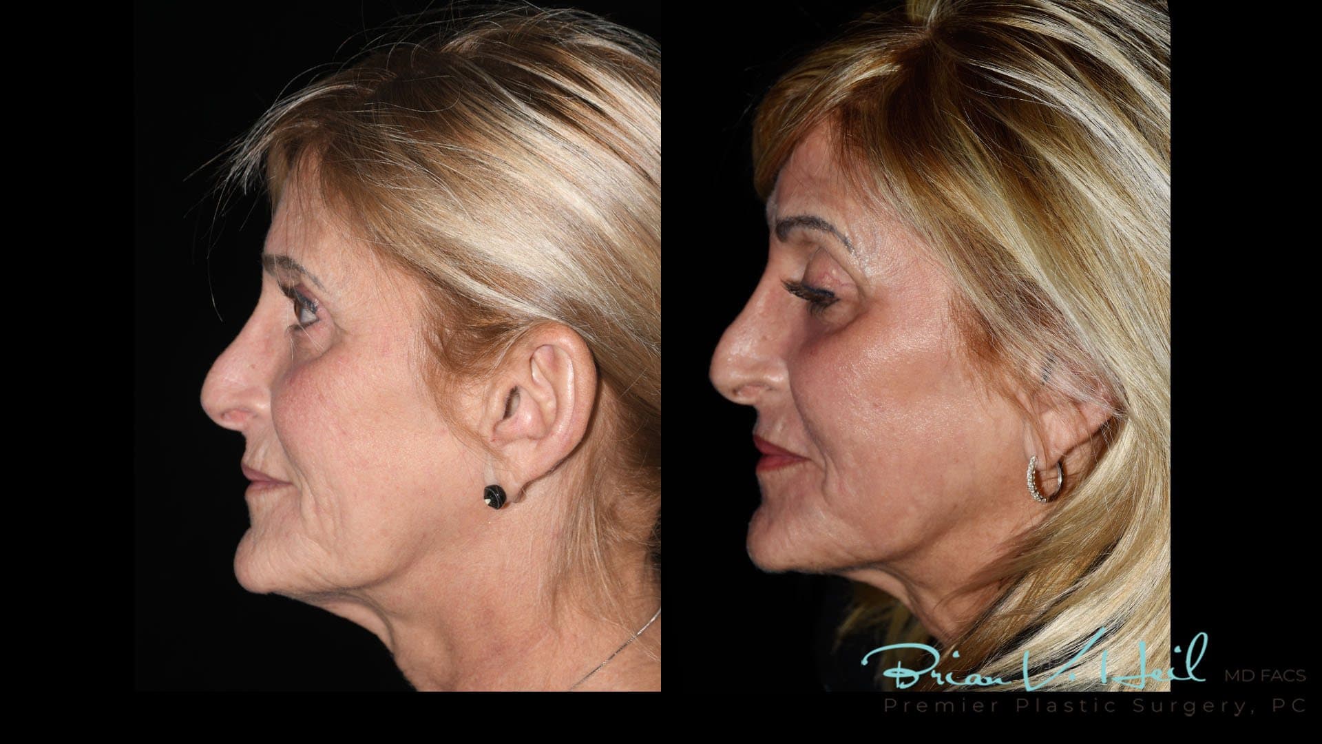 CO2 Laser Resurfacing, Patient 4, profile: before and after