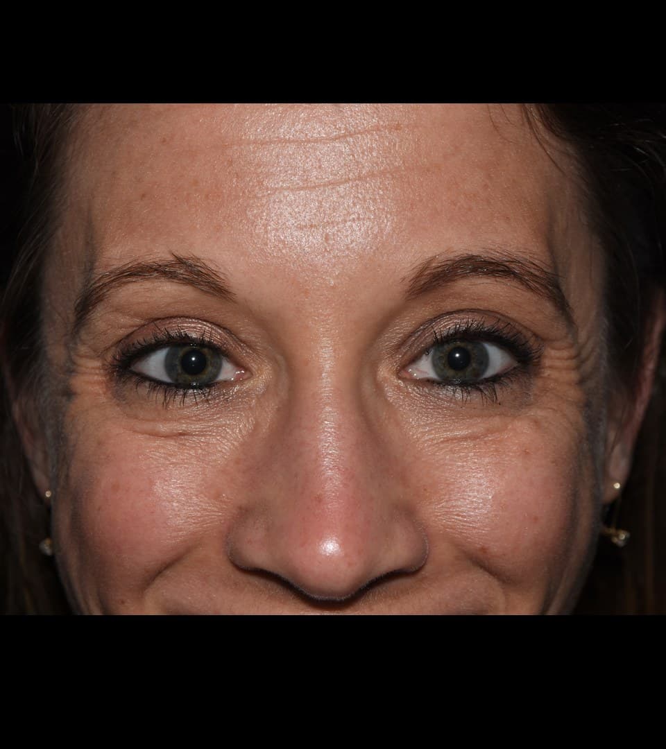 Crow's feet, before