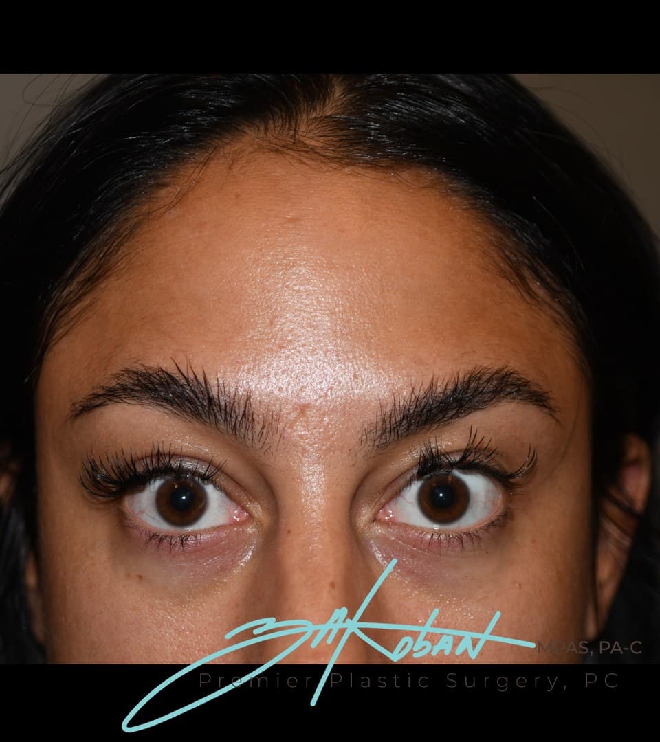 Forehead lines, after