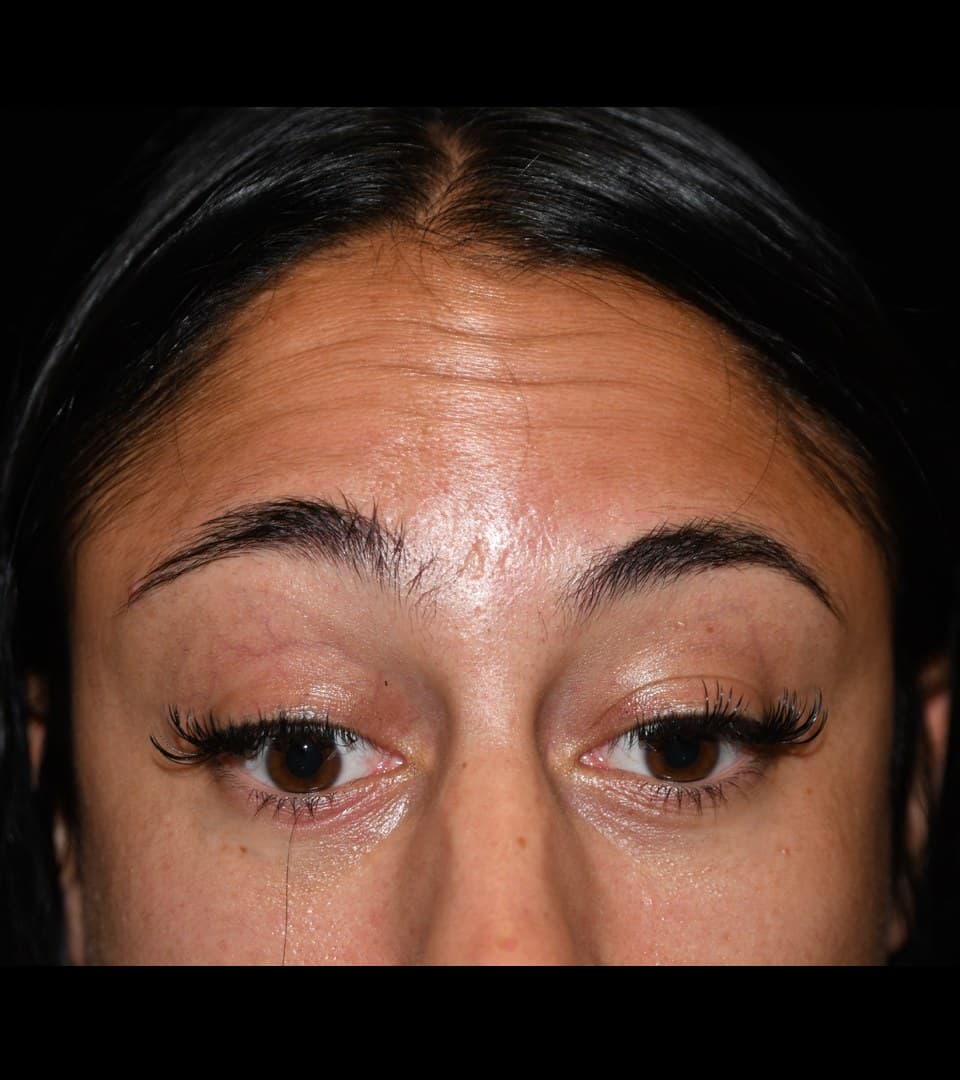 A woman's forehead, horizontal lines above the brows softened, before