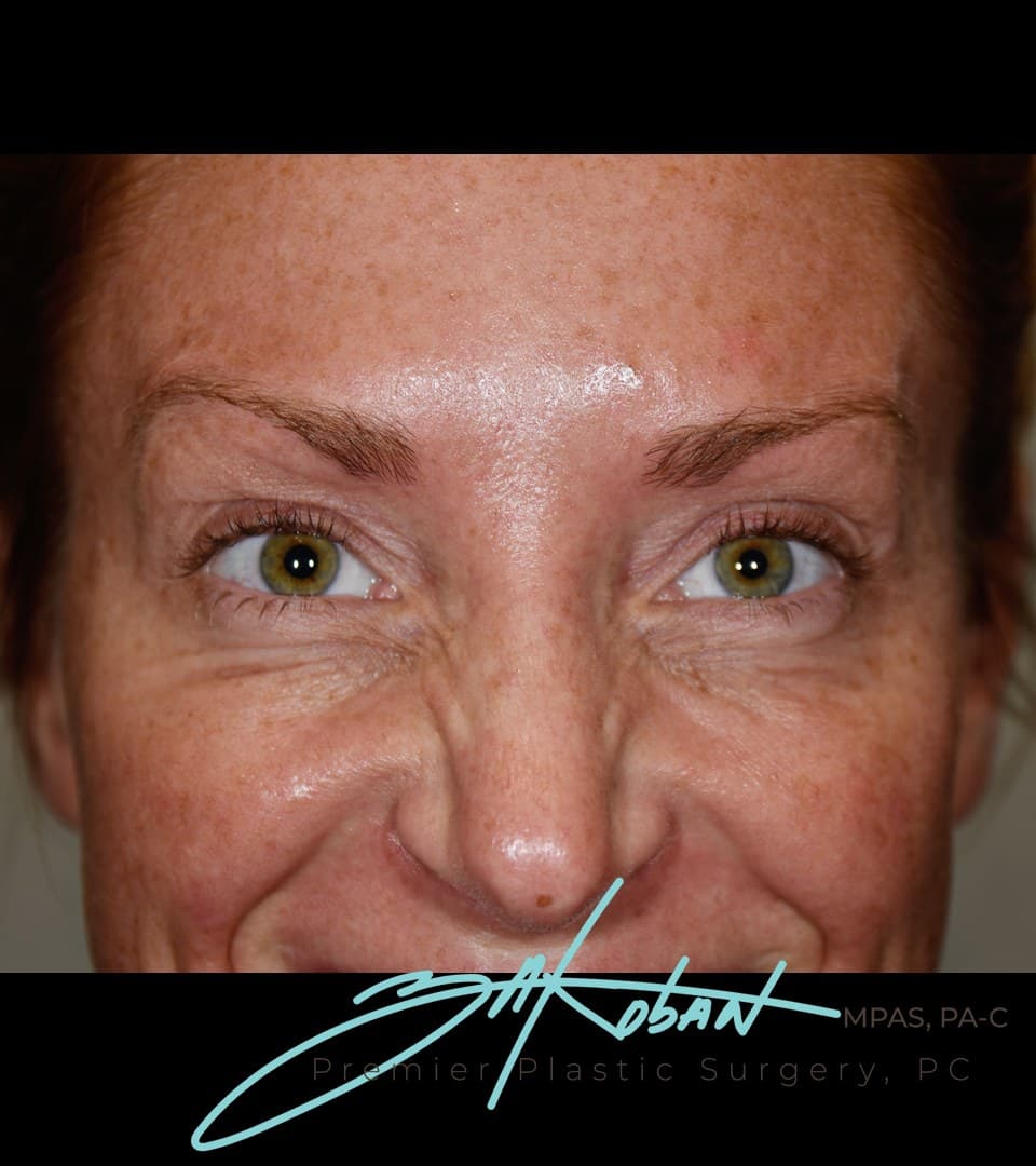 Forehead lines, after