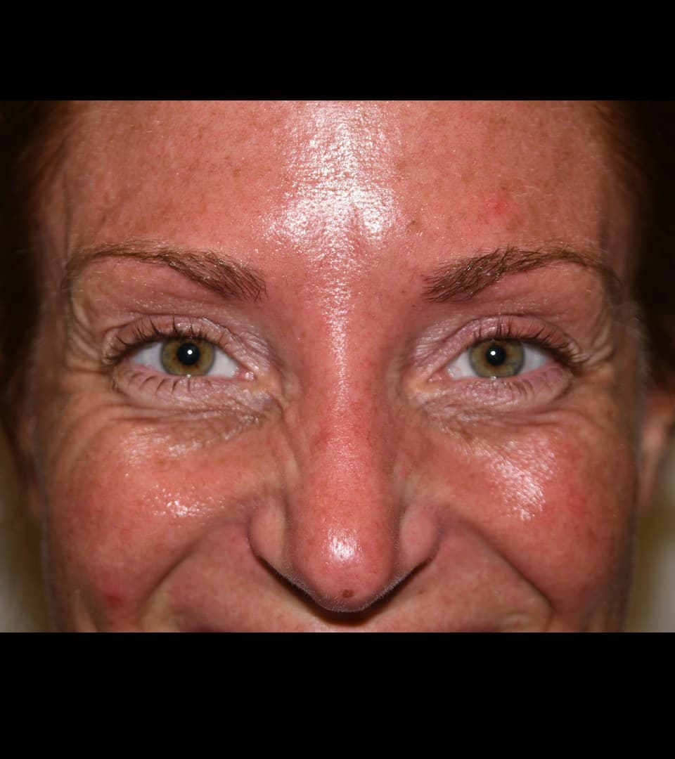Forehead lines, before