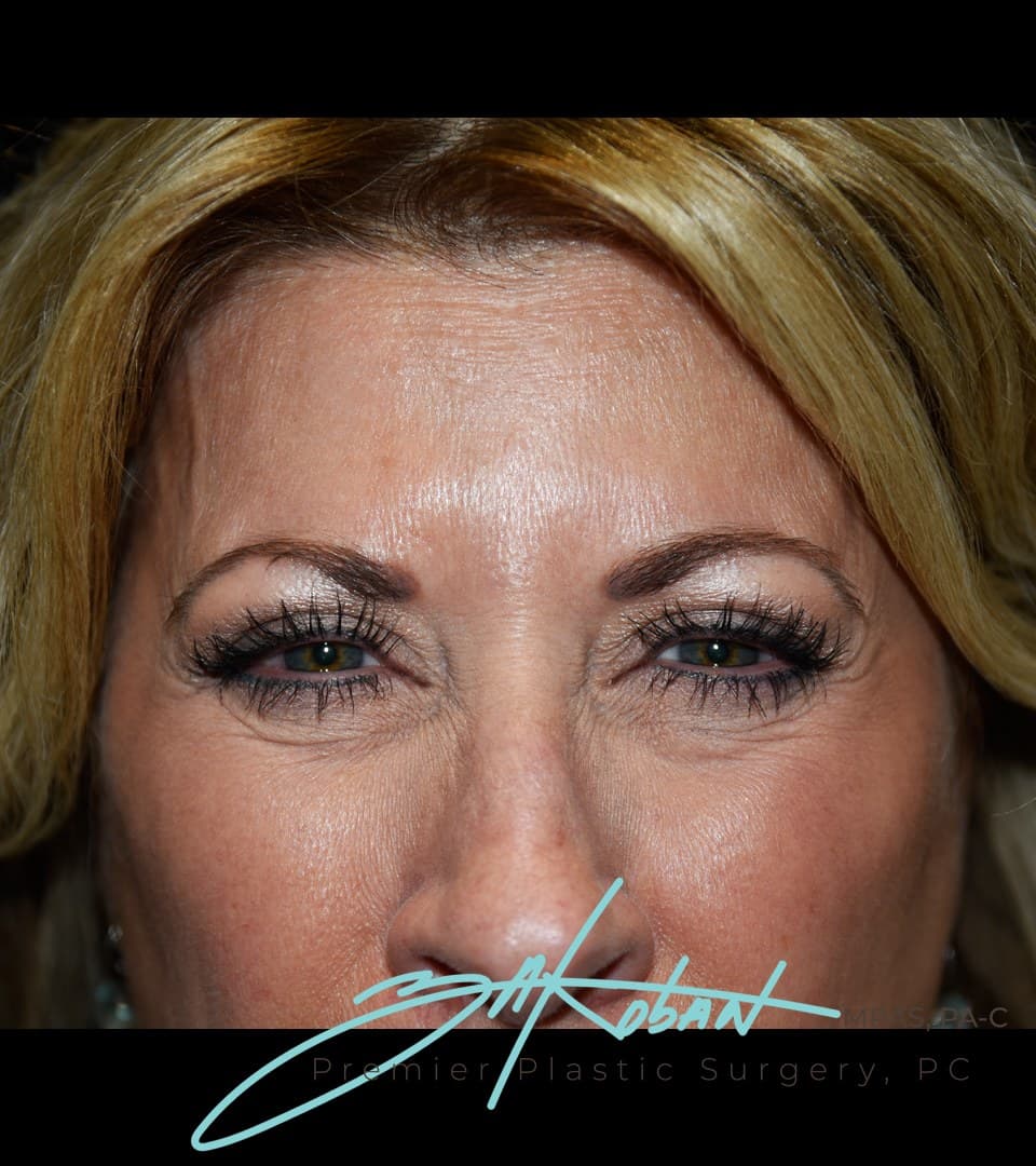 Frown lines, after