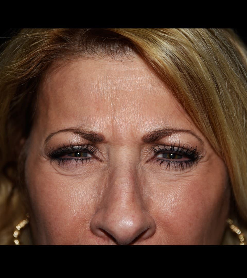 Frown lines, before