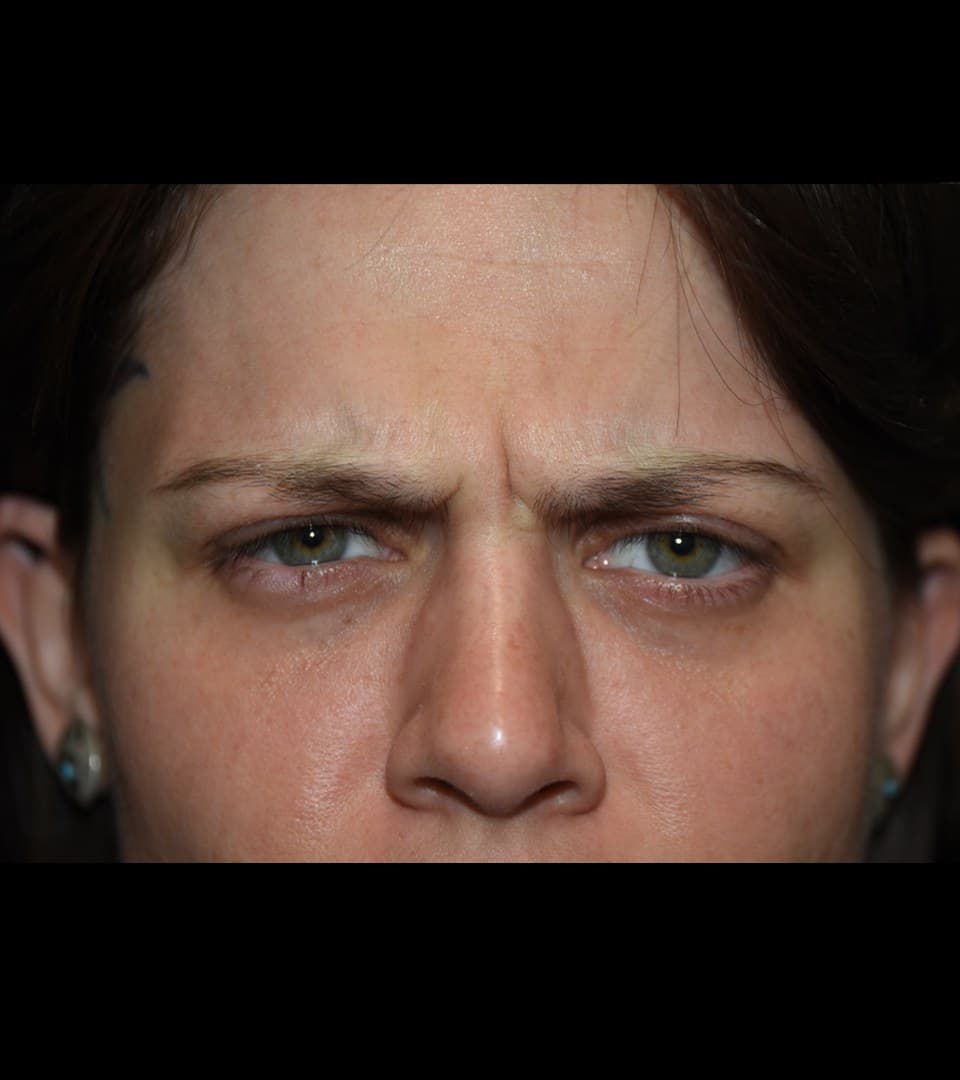Frown lines, before