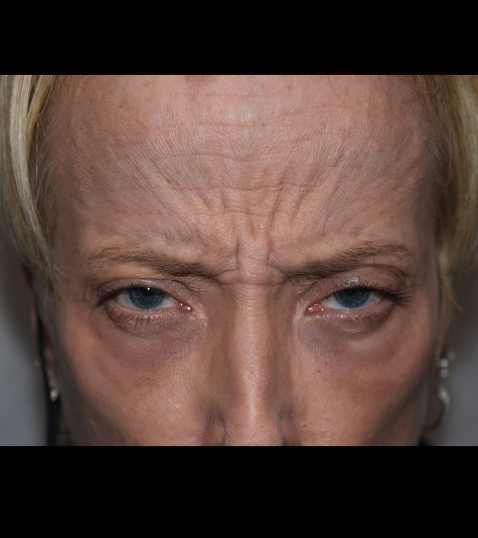 Frown lines, before