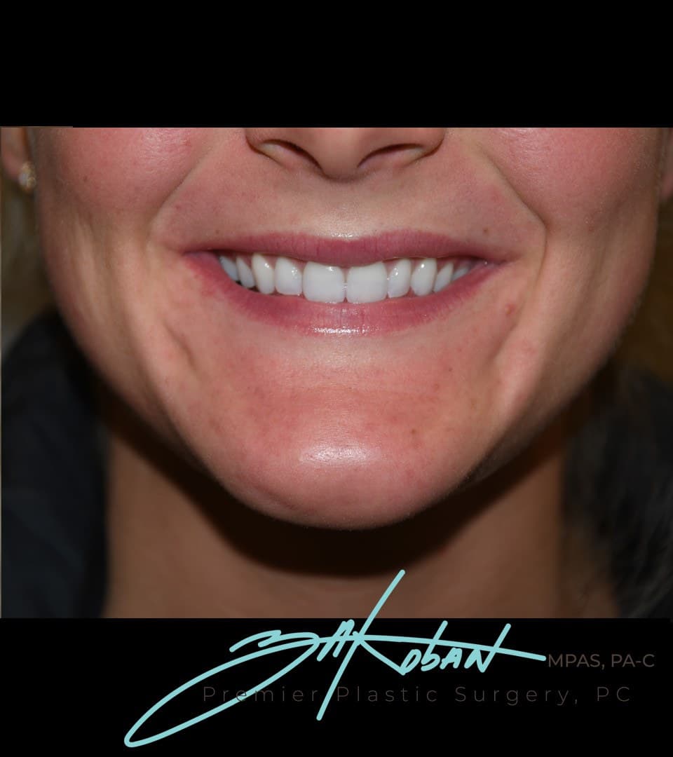 Gummy smile, after