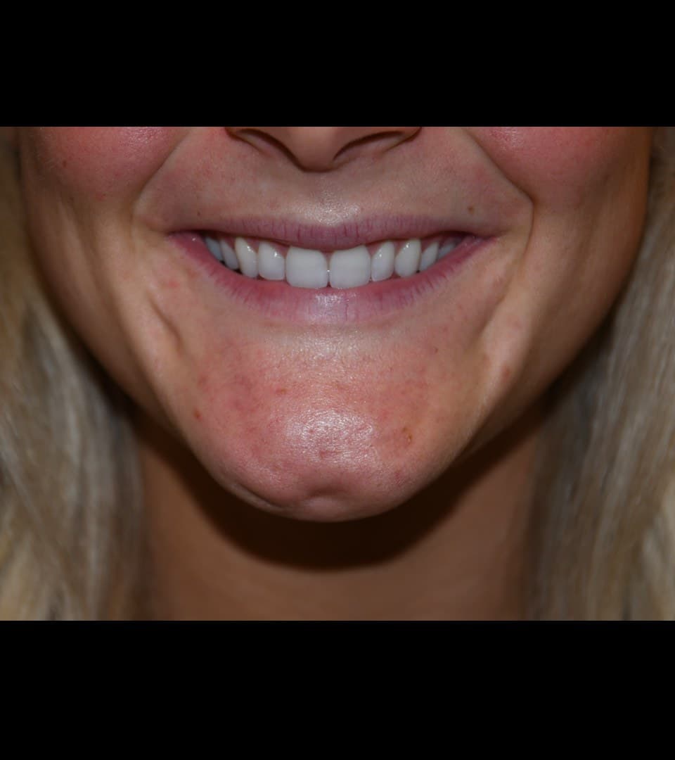 Gummy smile, before