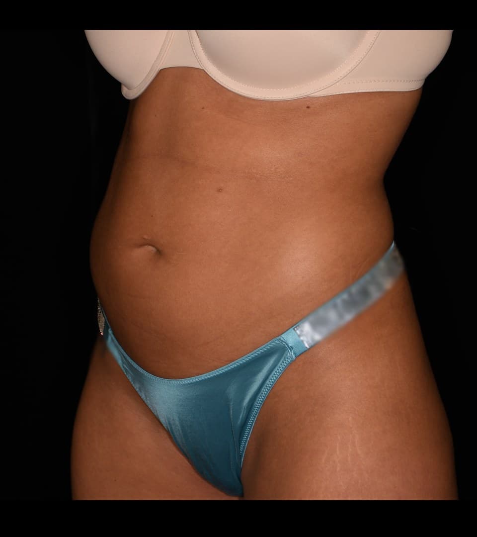Abdomen, oblique, before