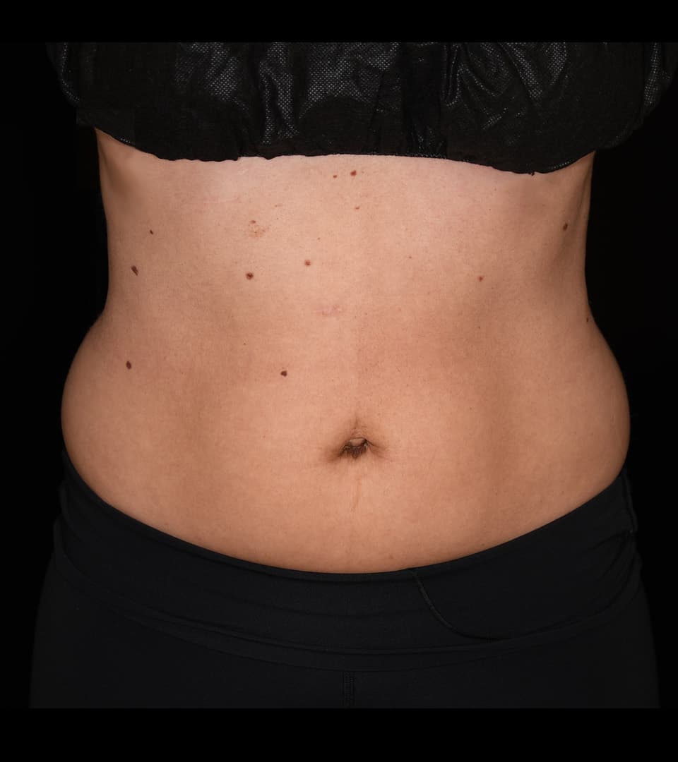 Second patient, front, before