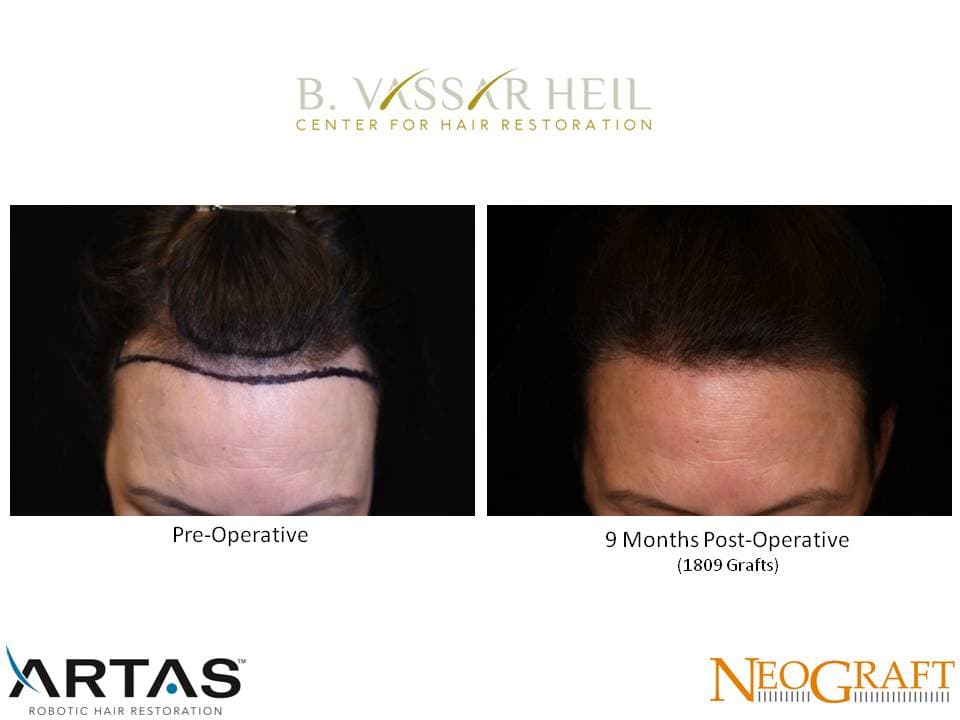 Hair Restoration, Patient 1: before and after