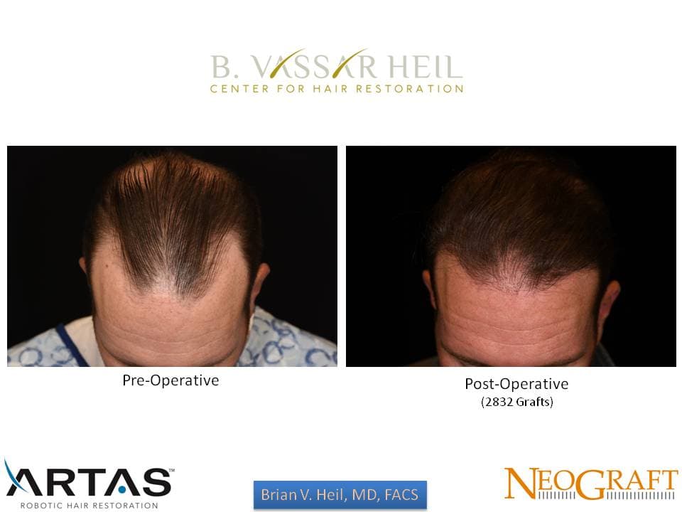 Hair Restoration, Patient 2: before and after
