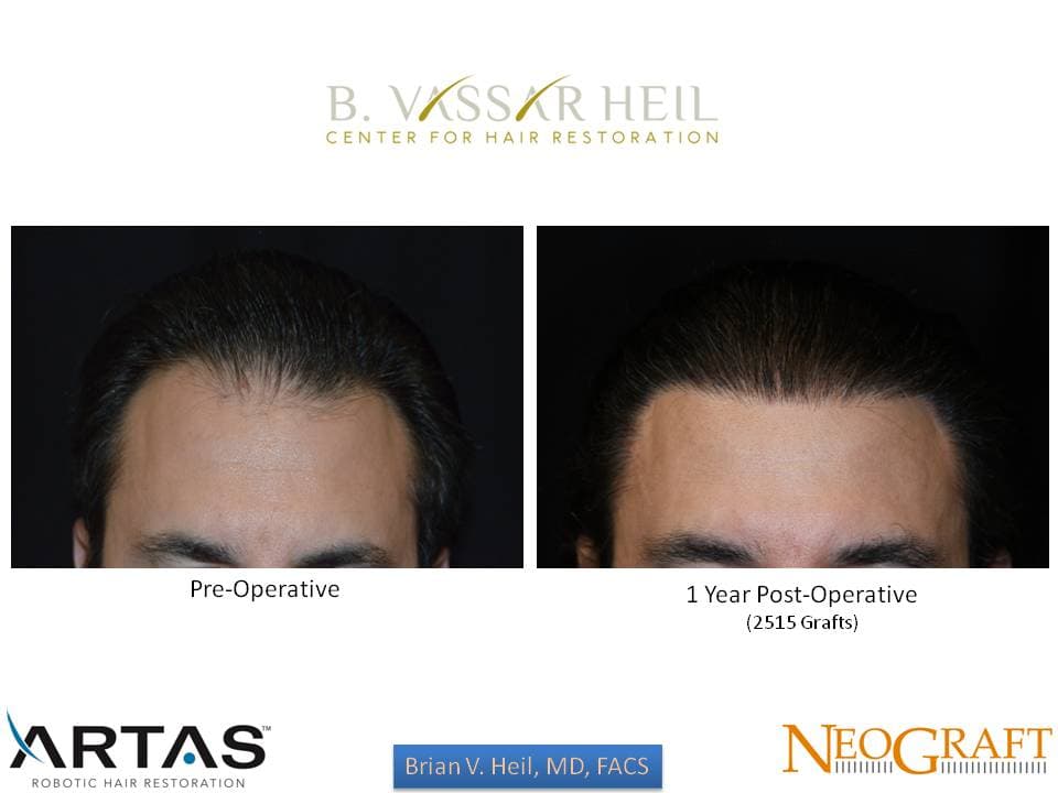 Hair Restoration, Patient 3: before and after