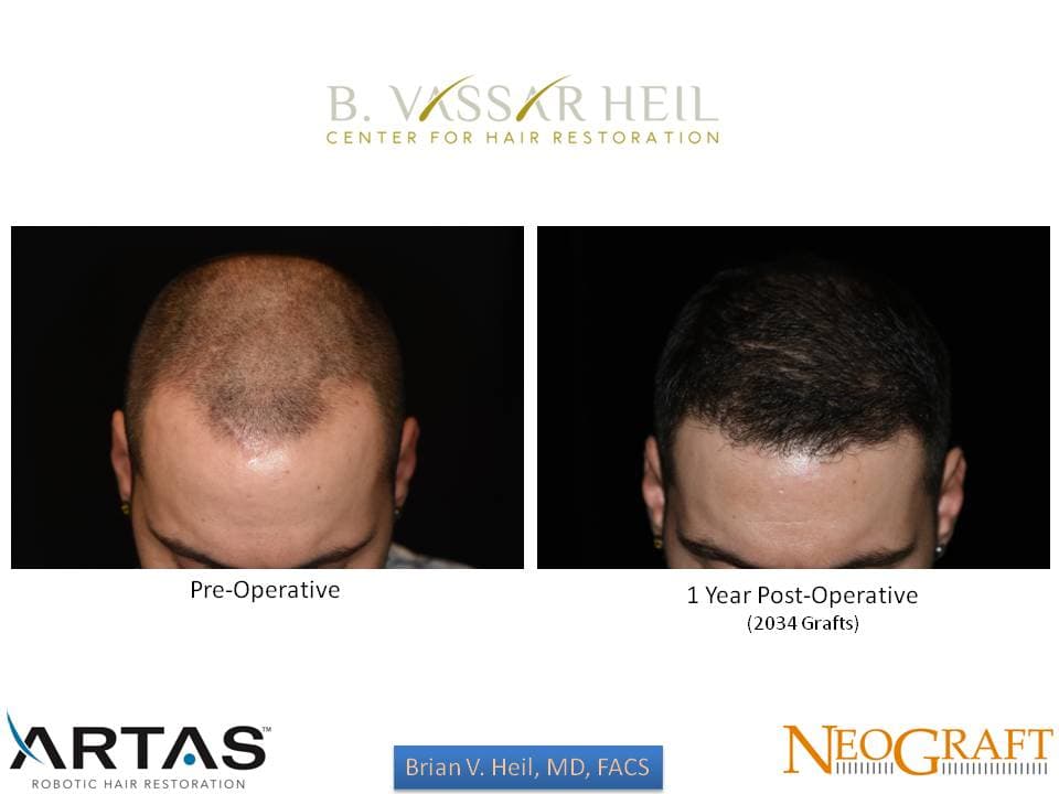 Hair Restoration, Patient 4: before and after