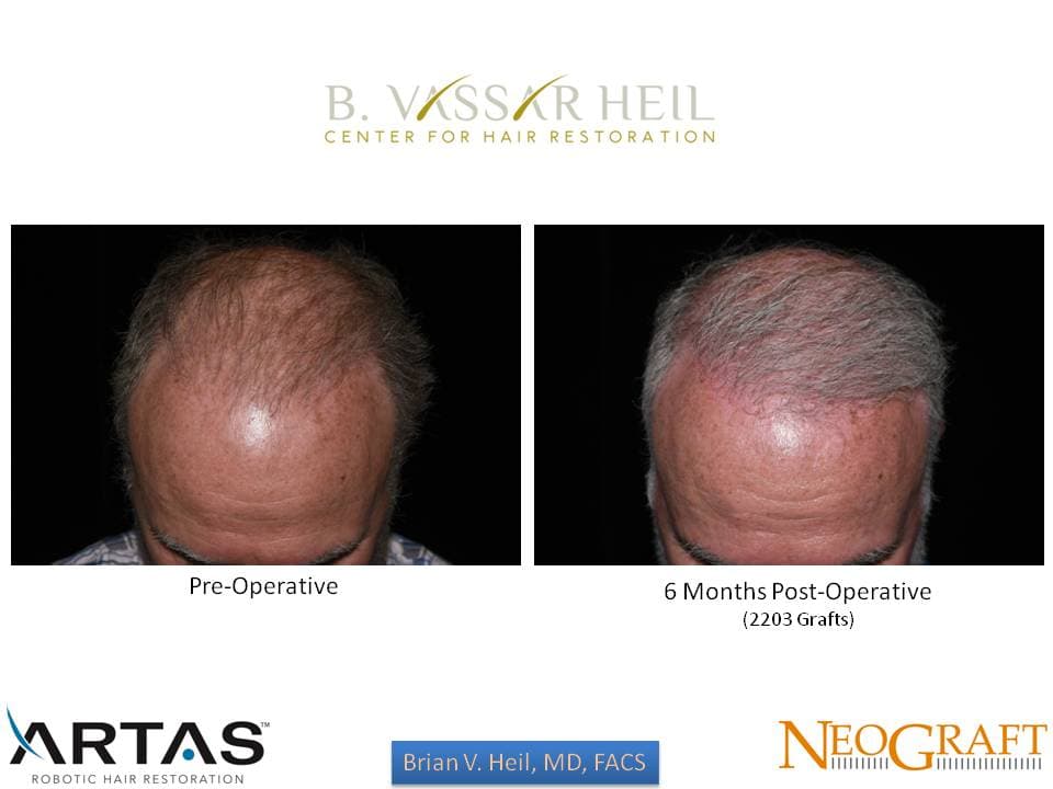 Hair Restoration, Patient 5: before and after