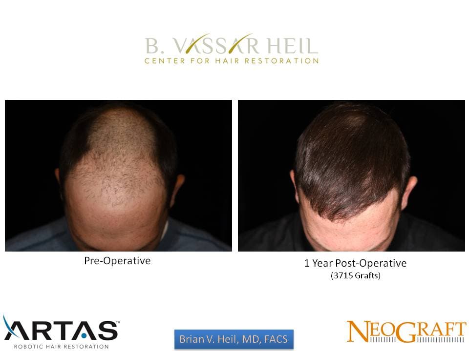 Hair Restoration, Patient 6: before and after