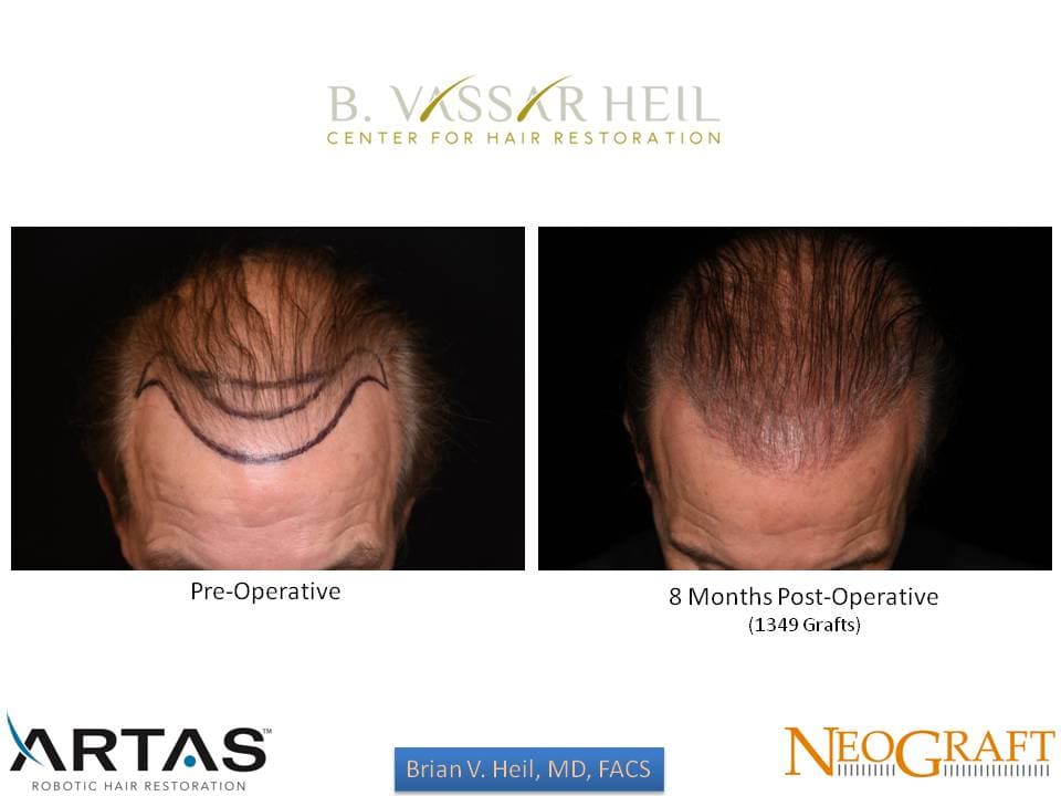 Hair Restoration, Patient 7: before and after