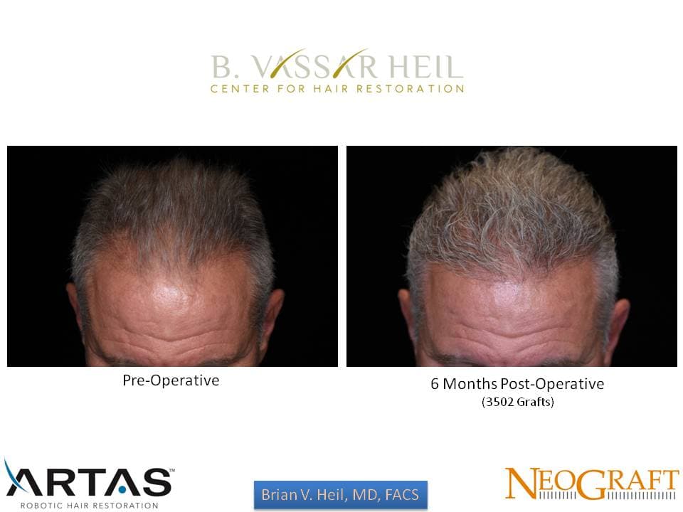 Hair Restoration, Patient 8: before and after