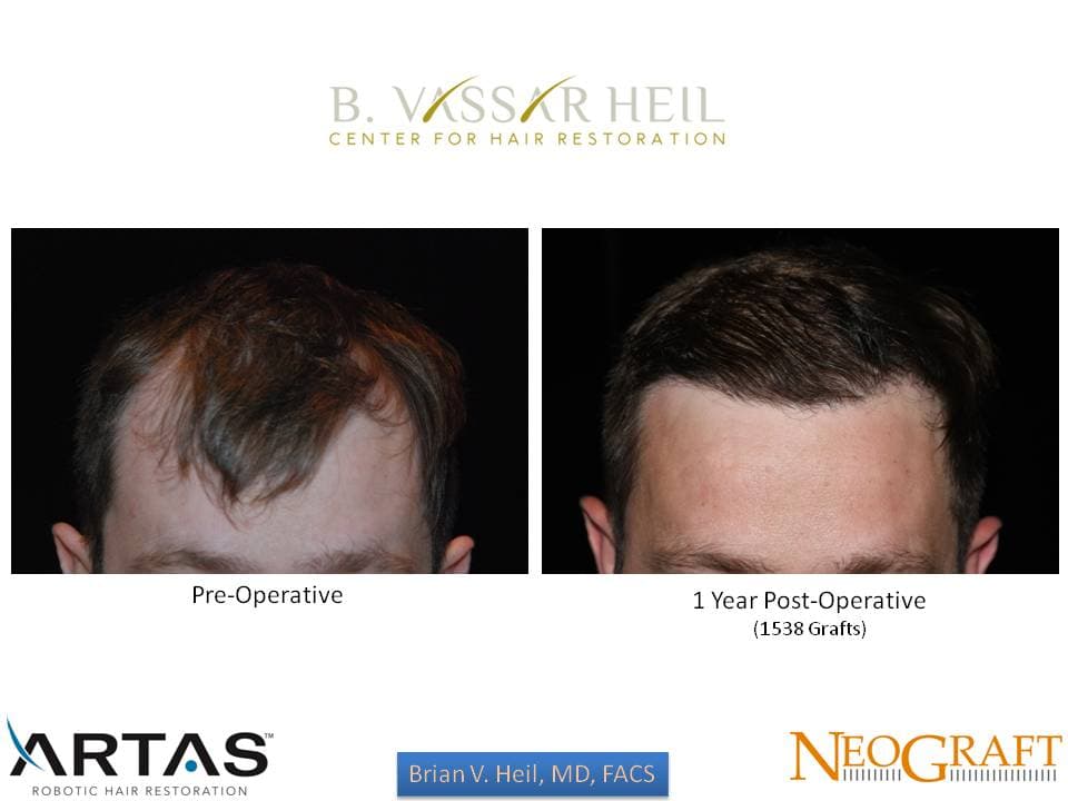 Hair Restoration, Patient 9: before and after