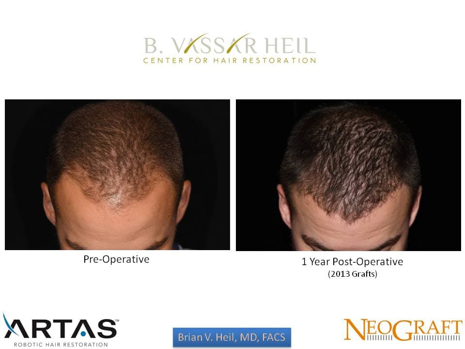 Hair Restoration, Patient 10: before and after