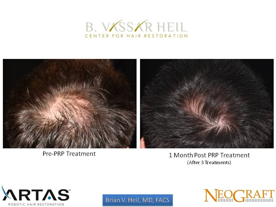 Hair Restoration, Patient 11: before and after