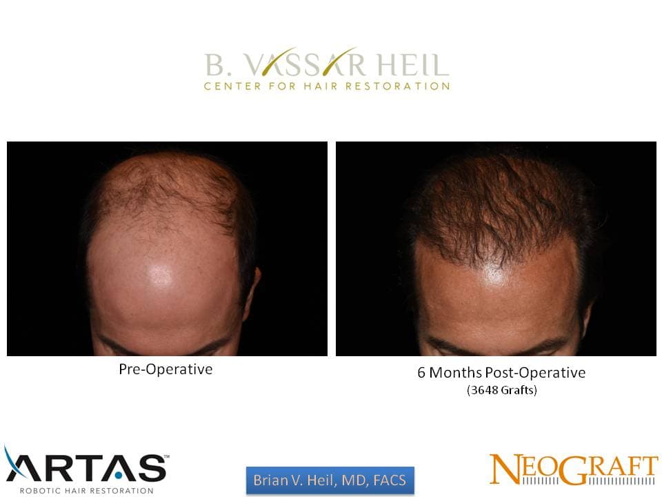 Hair Restoration, Patient 12: before and after