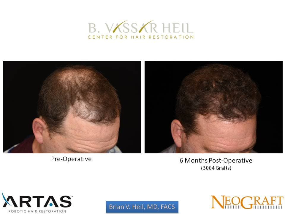 Hair Restoration, Patient 13: before and after