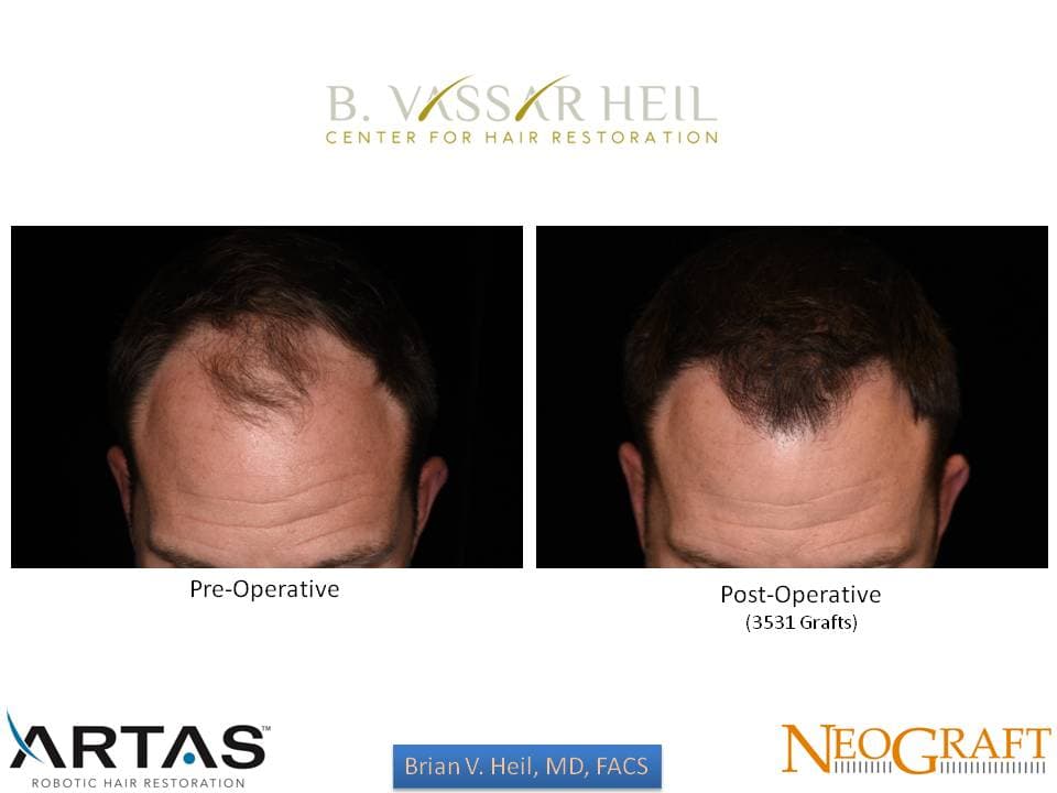 Hair Restoration, Patient 14: before and after