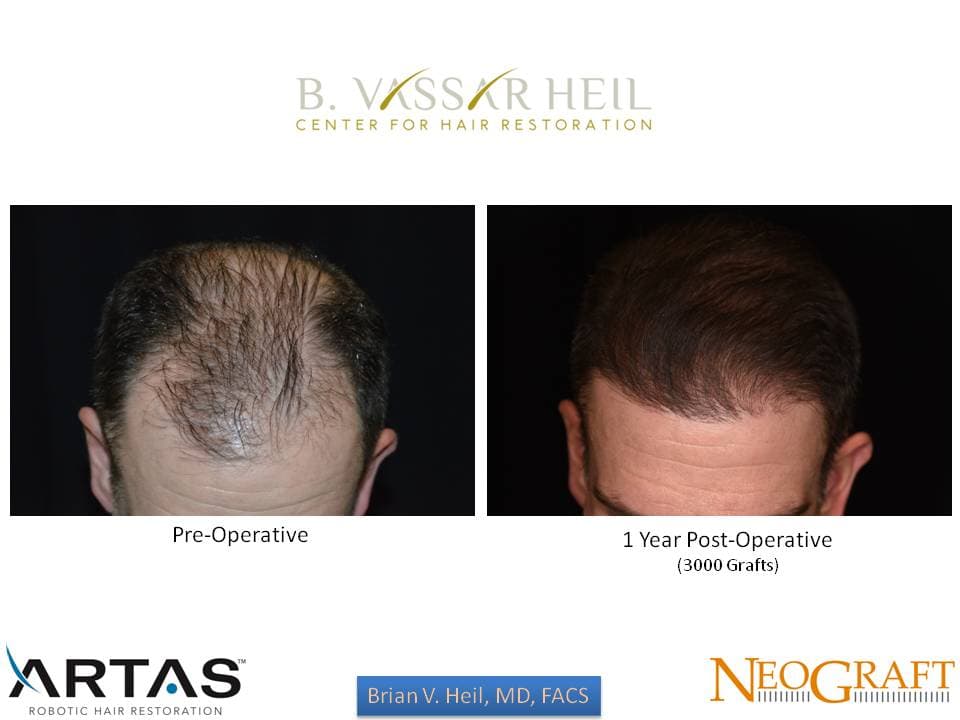 Hair Restoration, Patient 16: before and after