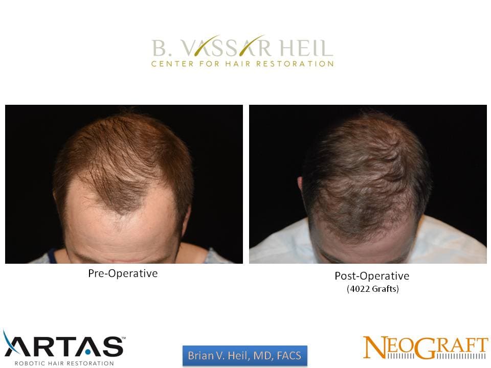 Hair Restoration, Patient 17: before and after