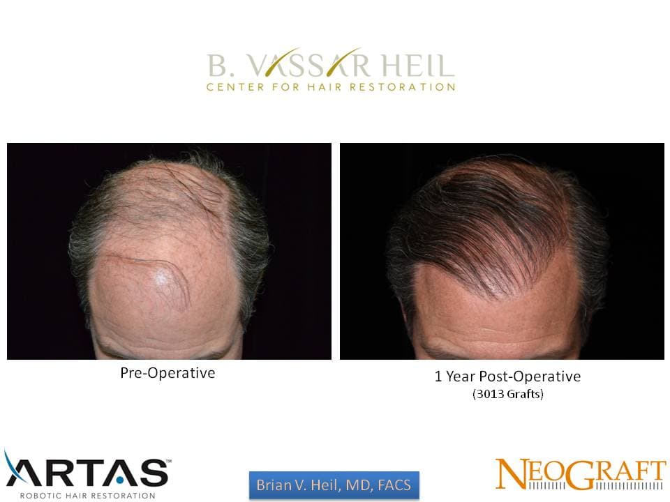 Hair Restoration, Patient 18: before and after