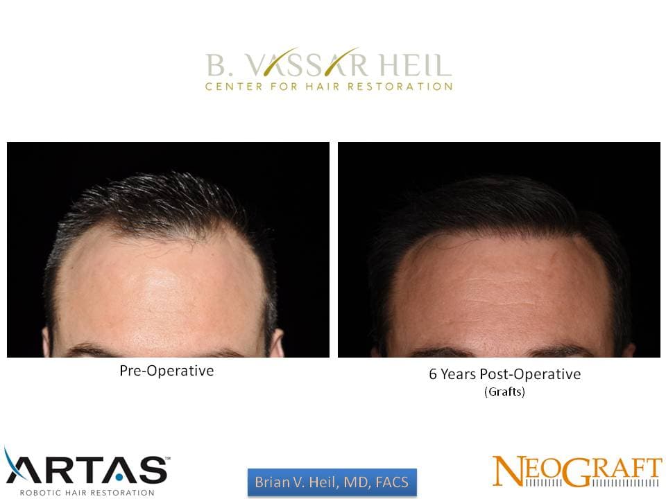 Hair Restoration, Patient 19: before and after