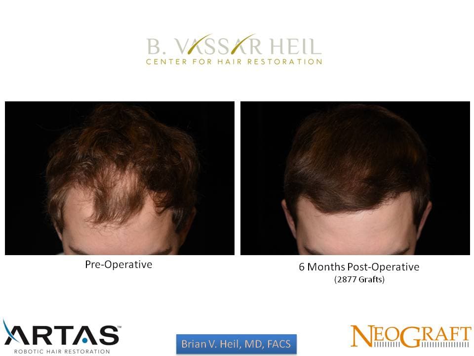 Hair Restoration, Patient 20: before and after